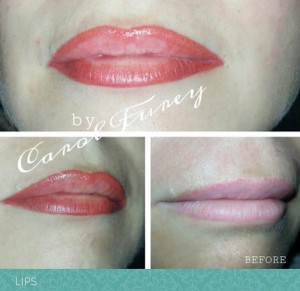 Labios antes y después de procedimiento